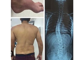 هشتم اسفند به عنوان روز بیماری های نادر نام گذاری شده است